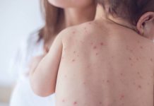 El sarampión reaparece ¿Qué debemos hacer en Chile?