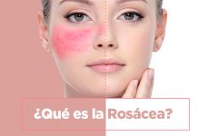 Rosácea, qué es y cómo tratarla