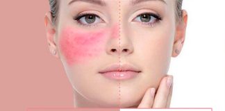 Rosácea, qué es y cómo tratarla