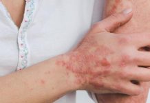 Brote de sarna: especialista llama a consultar para frenar su propagación