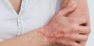 Brote de sarna: especialista llama a consultar para frenar su propagación