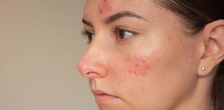 Rosácea: Por qué empeora con el frío y cómo aliviar los síntomas